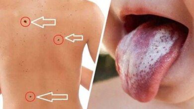 12 sinais de um câncer maligno que podem ser sutis