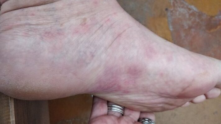 Fígado doente: Conheça alguns dos sinais nos pés que podem revelar problemas de saúde