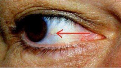 Os seus olhos podem indicar que está prestes a ter um ataque cardíaco