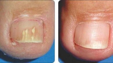 3 Dicas de como eliminar os fungos das unhas