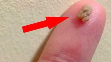 1 em cada 4 pessoas sofrem deste problema que causa mau hálito! Aprenda a corrigi-lo