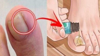 6 Remédios ancestrais para aliviar as unhas encravadas