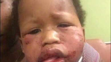 Bebê é agredido na creche, mãe mostra machucados e desabafa