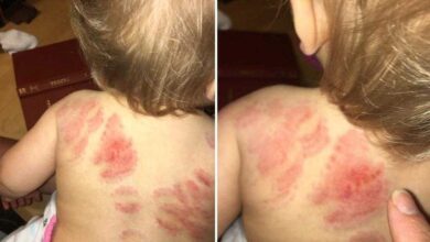 Mãe denuncia creche após filha de 1 ano receber mais de 25 mordidas nas costas