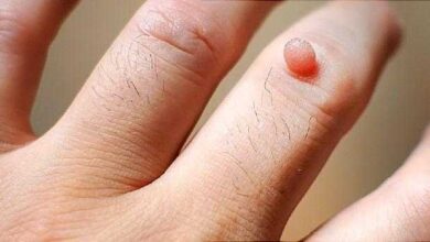 Como usar limão para eliminar verrugas em poucos dias