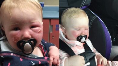 Bebê tem grave queimadura causada por 1 protetor solar e mãe alerta