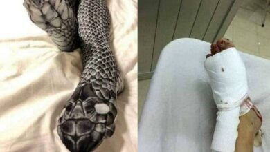 Mulher usa meia-calça diferente, assusta o marido e vai parar no hospital