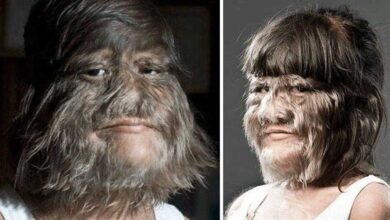 Mulher mais peluda do mundo se depila para seu casamento; confira as fotos do resultado