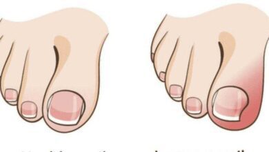 4 Dicas para acabar com unha encravada