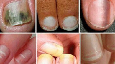 Suas unhas se encontram com algum destes aspectos? CUIDADO para o que pode significar