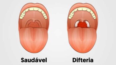 O Que é a Difteria?