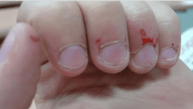 Onicofagia: Compulsão em roer unhas é sinal de alerta!