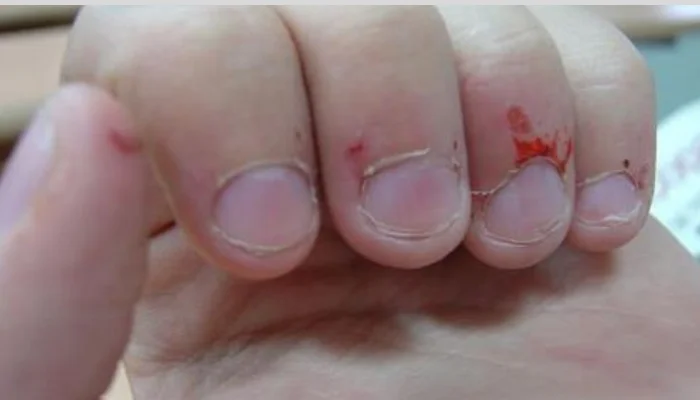 Onicofagia: Compulsão em roer unhas é sinal de alerta!