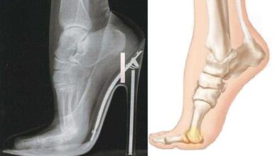 5 coisas assustadoras que acontecem com seu pé quando você usa salto alto 4f