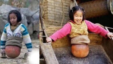 Lembra da menina que usava uma bola como pernas? Você não vai acreditar ao ver como está hoje