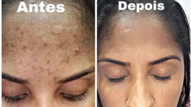 5 Mascaras caseiras para remover manchas e cicatrizes do rosto