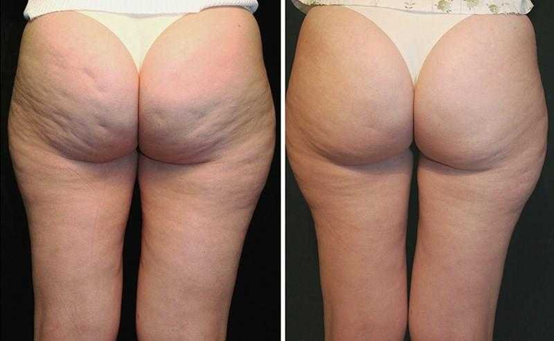 3 Tratamentos naturais para estrias