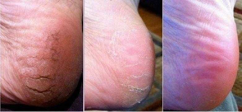 4 remédios caseiros simples para rachaduras nos pés 4q