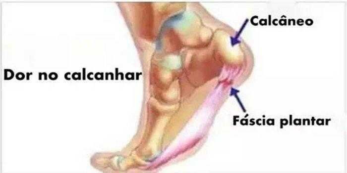 5 formas de tratar a dor no calcanhar naturalmente e eliminá-la para sempre!