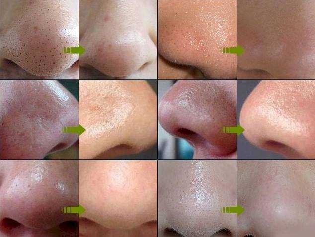 6 Receitas caseiras para eliminar cravos