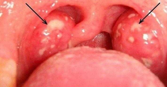 fim-da-dor-de-garganta