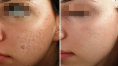 9 Receitas caseiras para fechar os poros