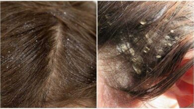 Aprenda como se livrar das caspas