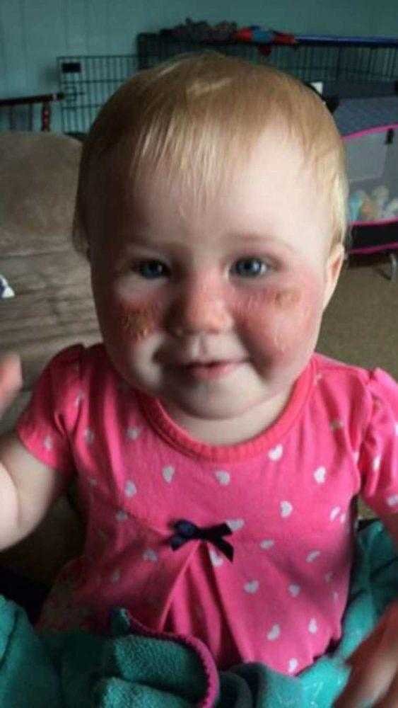 Bebê sofre queimadura de 2º grau em sua face por algo toda a gente utiliza no verão!