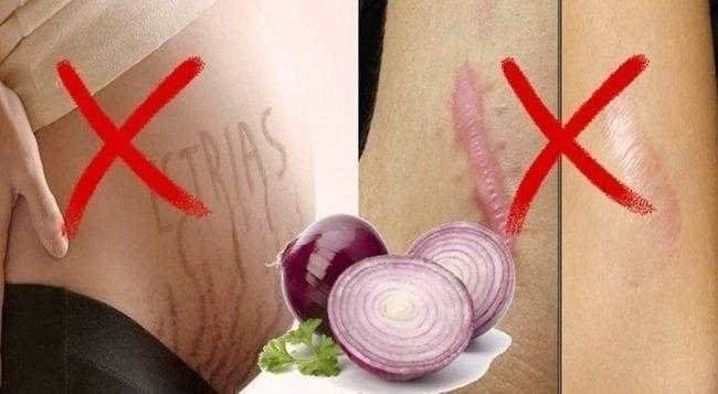Cebola para eliminar estrias e cicatrizes