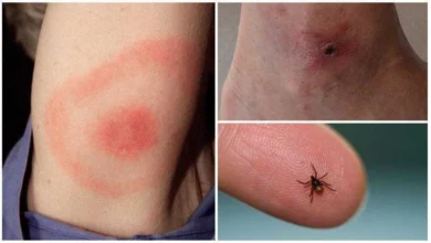 Cientistas alertam para um novo vírus letal transmitido por carrapatos – pior do que a doença de Lyme