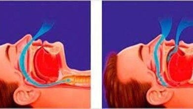 Conheça os riscos de ronco e o impacto na sua saúde