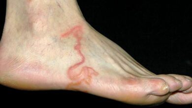 Ele pensa que são varizes, mas quando o médico olha seu pé… chocante!