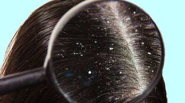 Os melhores remédios caseiros para acabar com a caspa