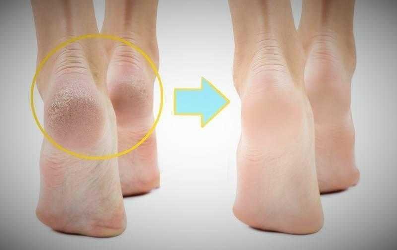 Pé rachado? Solução MAIS barata do mundo!