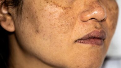 Receita caseira ELIMINAR manchas indesejáveis na pele