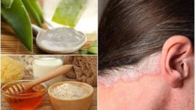 Remédios Caseiros Para Psoríase | Bau das DICAS