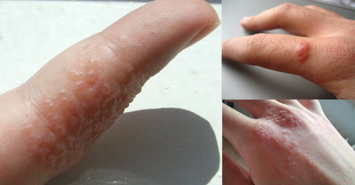Se surgirem bolhas em suas mãos e pés, fique atento; pois pode ser sintomas de…