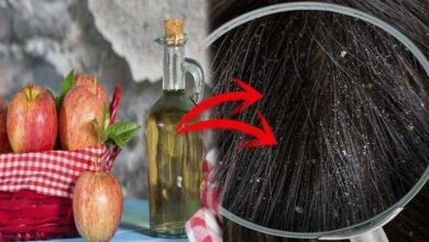 Aprenda a controlar a caspa usando vinagre