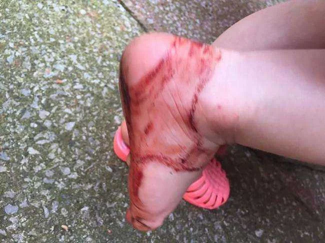 Atenção com as sandálias de plástico, veja o que aconteceu com essa menina!