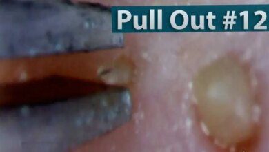 Aviso! imagens chocantes a seguir - você nunca mais vai espremer cravos