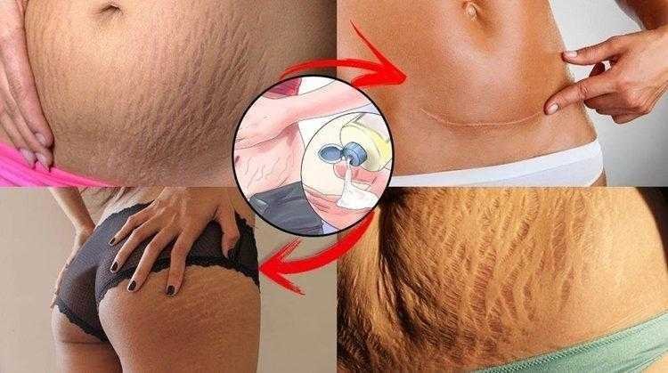 Cebola para eliminar estrias e cicatrizes. FANTÁSTICO!