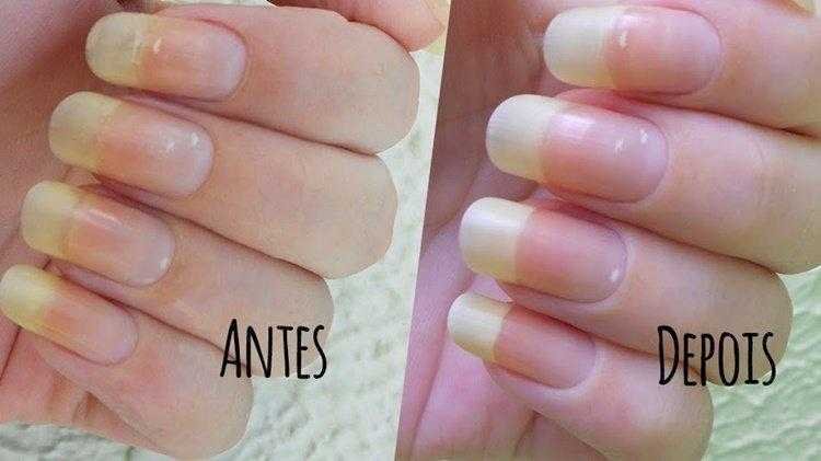 Clareie suas unhas amareladas em casa