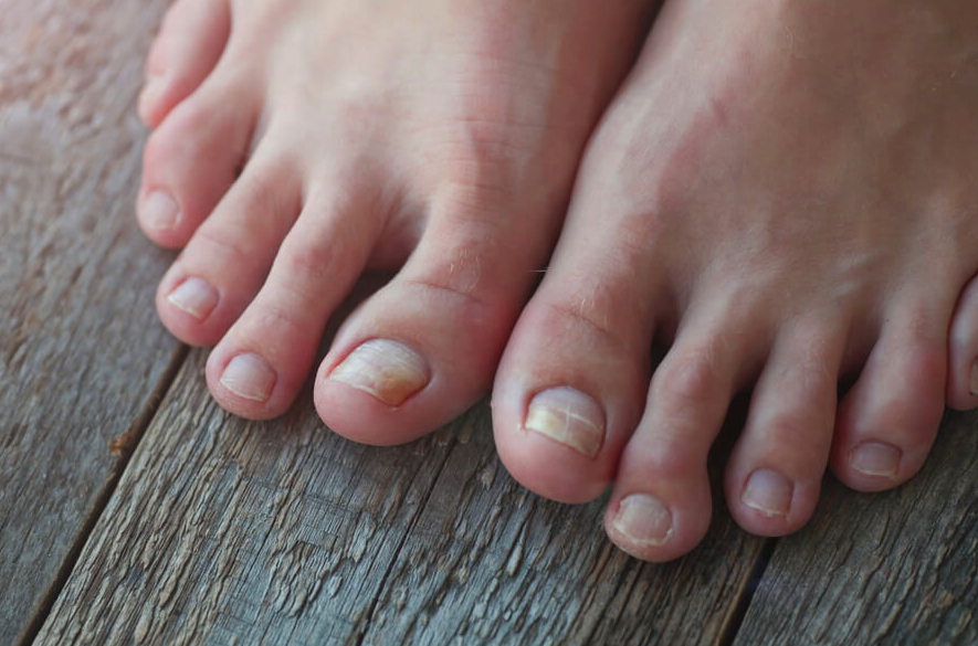 como eliminar fungos nas unhas dos pés e mãos