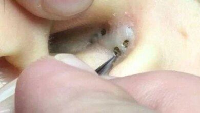 Cravos são retirados de dentro da orelha de mulher