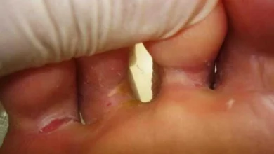 Elimine as frieiras com remédios caseiros