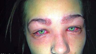 Garota quase fica cega por causa de um erro que várias mulheres cometem