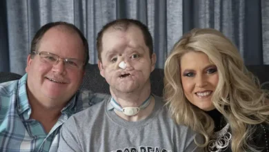 Homem realiza transplante de rosto que durou 50 horas após tentar tirar a própria vida; veja antes e depois