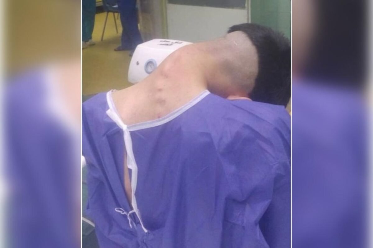 homem sofre de sindrome rara de queda da cabeca causada por vicio 1 e1747233775298