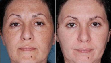 Máscara milagrosa para melasma e manchas no rosto
