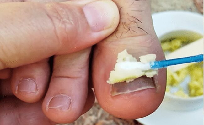 Os Melhores REMÉDIOS CASEIROS Para MICOSE DE UNHA!